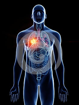 A mans bronchi cancer