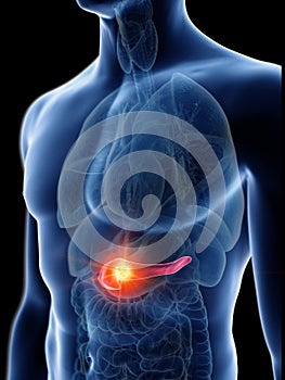 a mans pancreas tumor