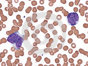 Mantle cell lymphoma. Peripheral blood.