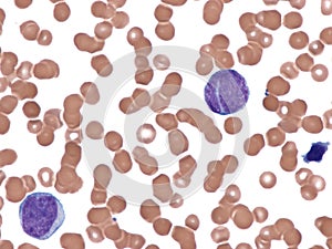Mantle cell lymphoma. Peripheral blood.