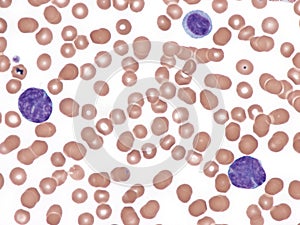 Mantle cell lymphoma. Peripheral blood.