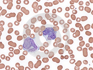 Mantle cell lymphoma. Peripheral blood.