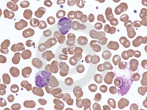 Mantle cell lymphoma in peripheral blood. photo