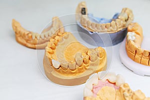 The manufacture of dental implants. Modeling and restoration of lost teeth in a dental laboratory