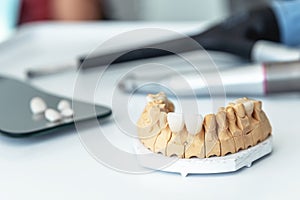 Manufacture of veneers, dental implants and crowns in the dental laboratory.