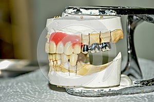 Manufacturing of dental prostheses, metal-ceramic crowns on gypsum teeth models in the treatment of patients by a dentists