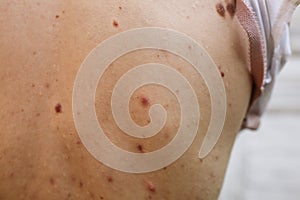 Many birthmarks on the girl`s back. Medical health photo. Woman`s oily skin with problems acne