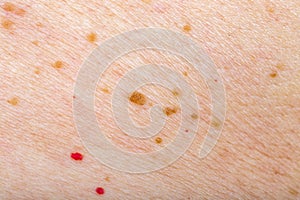 Many nevus and cherry angioma on human skin photo