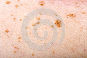 Many nevus on human skin