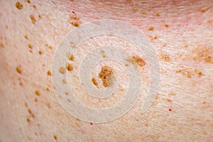Many nevus on human skin photo