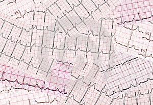 Many results of cardiogram are sparse chaotically. Abstract background