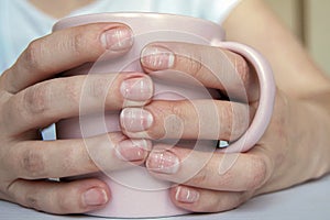 Many white spots on fingernails Leukonychia due to calcium deficiency or stress, hands holding mug photo