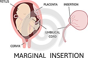 Marginal insertion of umbilical cord. insertion site varies