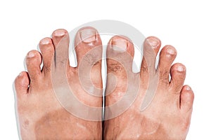 Mark of sunburn on bare foot
