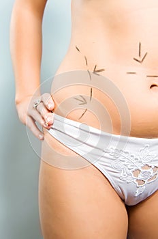Marks on abdomen for plastic surgery