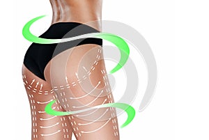 Marks on the women`s buttocks, waist and legs before plastic surgery.