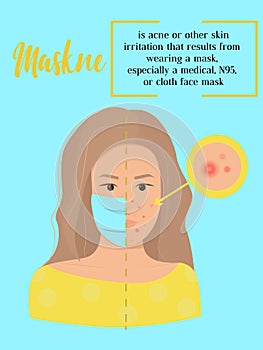 Maskne concept. Infographic vector illustration with defenition of mascne - acne or irritation caused by wearing protective face