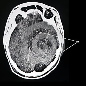 Massive brain infarction. CT-scan examination.