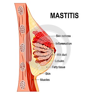 Mastitis. Cross-section of the mammary gland with inflammation o