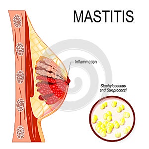 Mastitis. inflammation of the breast abscess formation. photo