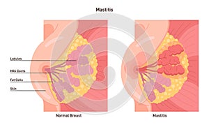 Mastitis. Mammary gland with inflammation of the breast lobular photo