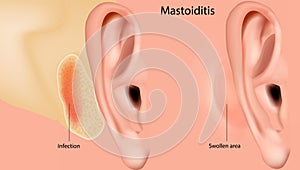 Mastoiditis. Inflammation of the mucosal lining of the mastoid antrum and mastoid air cell system inside the mastoid photo
