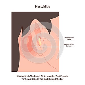 Mastoiditis. Inflammatory disease of the ear. Bacterial mastoid photo