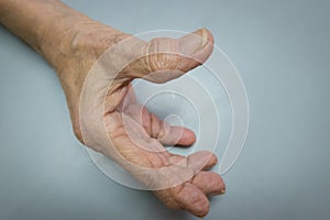 Mature patient with osteoarthritis on the hands