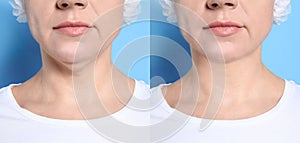 Mature woman before and after plastic surgery operation on blue background. Double chin problem