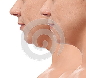 Mature woman before and after plastic surgery operation on white background. Double chin problem