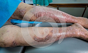 Mature woman with psoriasis in lower extremities photo