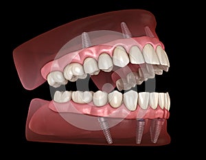 Maxillary and Mandibular prosthesis with gum All on 4 system supported by implants. Medically accurate 3D illustration