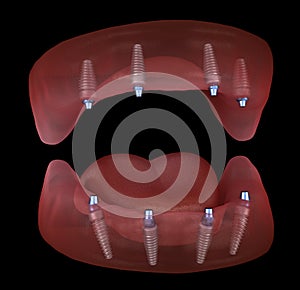 Maxillary and Mandibular prosthesis with gum All on 4 system supported by implants. Medically accurate 3D illustration