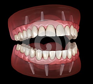 Maxillary and Mandibular prosthesis with gum All on 4 system supported by implants. Medically accurate 3D illustration