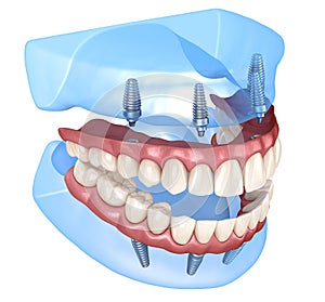 Maxillary and Mandibular prosthesis with gum All on 4 system supported by implants. Medically accurate 3D illustration of human