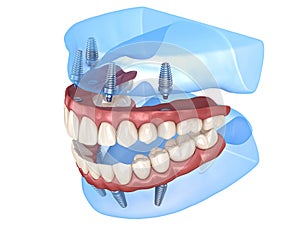 Maxillary and Mandibular prosthesis with gum All on 4 system supported by implants. Medically accurate 3D illustration of human