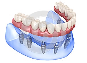 Maxillary and Mandibular prosthesis with gum All on 8 system supported by implants. Medically accurate 3D illustration of human