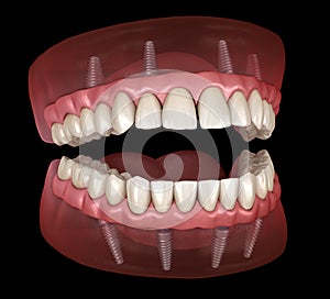 Maxillary and Mandibular prosthesis with gum All on 4 system supported by implants. Medically accurate 3D illustration photo