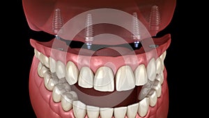 Maxillary prosthesis All on 4 system supported by implants. Medically accurate 3D animation of human teeth and dentures