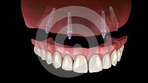 Maxillary prosthesis All on 4 system supported by implants. Medically accurate 3D animation of human teeth and dentures