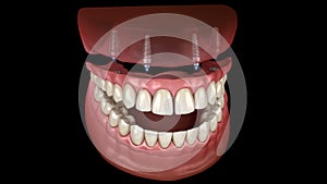 Maxillary prosthesis All on 4 system supported by implants. Medically accurate 3D animation of human teeth and dentures concept