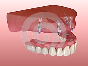 Maxillary prosthesis with gum All on 4 system supported by implants. Medically accurate 3D illustration of human teeth