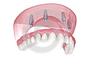 Maxillary prosthesis with gum All on 4 system supported by implants. Medically accurate 3D illustration of human teeth and