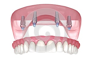 Maxillary prosthesis with gum All on 4 system supported by implants. Medically accurate 3D illustration of human teeth and