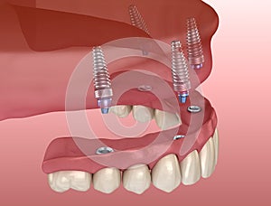 Maxillary prosthesis with gum All on 4 system supported by implants. Medically accurate 3D illustration of human teeth