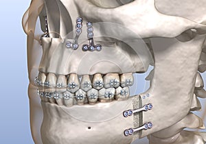 Maxillomandibular Advancement surgery. Medically accurate dental 3D illustration