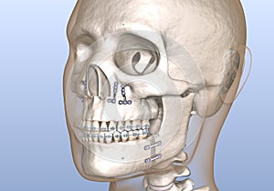 Maxillomandibular Advancement surgery. Medically accurate dental 3D illustration