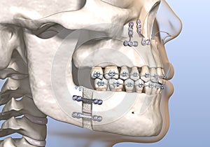 Maxillomandibular Advancement surgery. Medically accurate dental 3D illustration photo