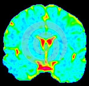 Mean Diffusivity Brain Map in Coronal View