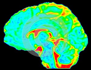 Mean Diffusivity Brain Map in Sagittal View